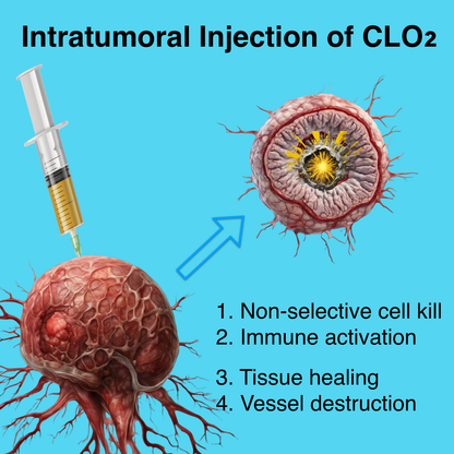 Programa de inyección intratumoral de dióxido de cloro